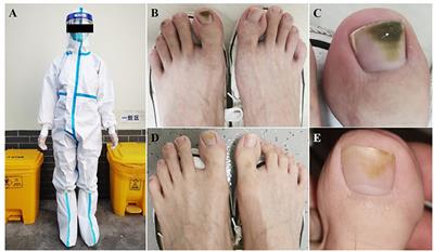 Case report: Green nail syndrome in an epidemic prevention volunteer during the outbreak of the Omicron in Shanghai